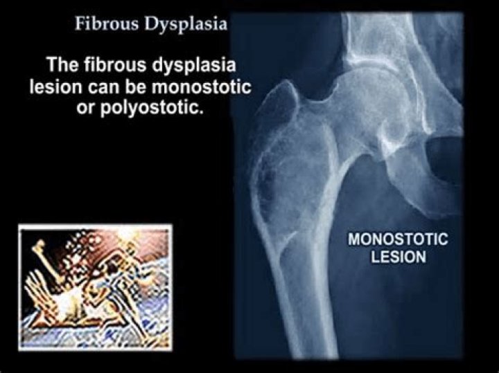 What is polyostotic fibrous dysplasia?
